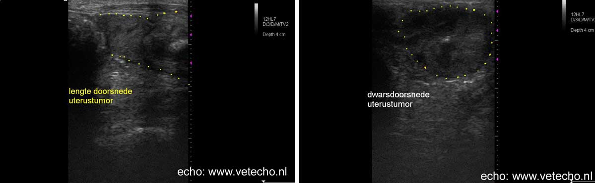 Op de echo is de baarmoeder tumor te zien.